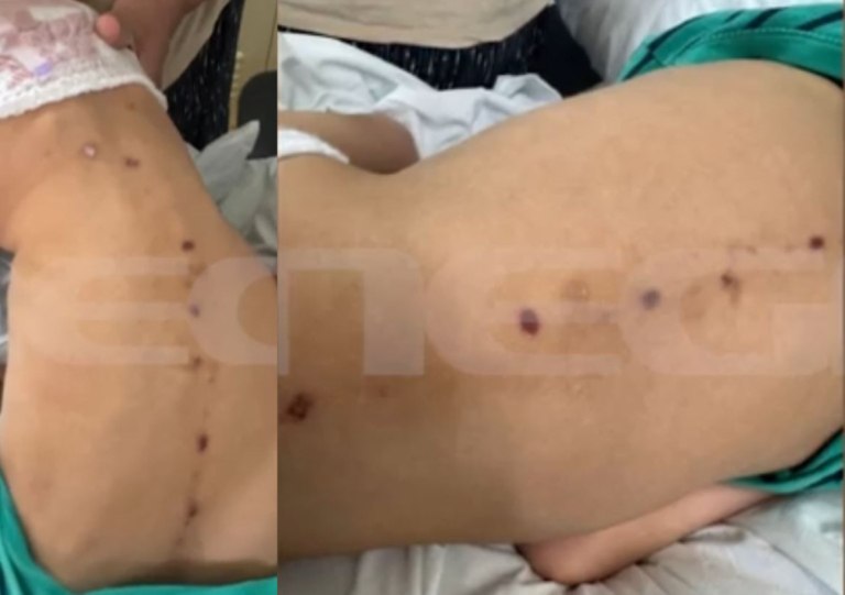 Νέα στοιχεία για την υπόθεση του 10χρονου παιδιού με τα σημάδια σε όλο του το κορμί