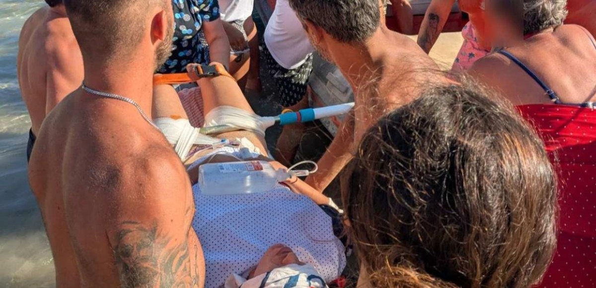 Δονούσα: Σοκαριστικό ατύχημα, ομπρέλα καρφώθηκε στο πόδι λουόμενης – Καταγγελία για ελλείψεις στο ΕΣΥ