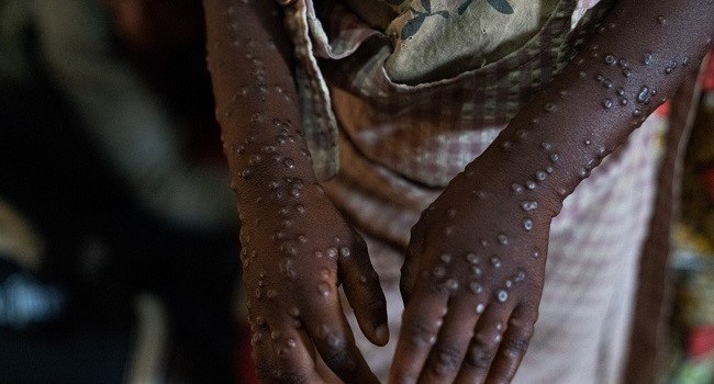 mpox: Καταγράφηκε ο πρώτος θάνατος στην Γκάνα