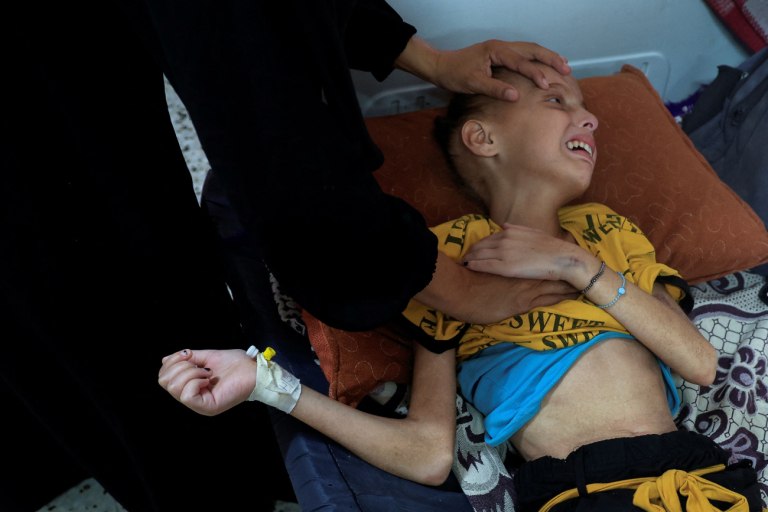 Γάζα: Σχεδόν 12.000 παιδιά με οξύ υποσιτισμό τον Ιούλιο, ο υψηλότερος αριθμός που έχει καταγραφεί ποτέ