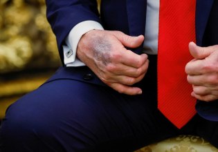 Το μελανιασμένο χέρι του Τραμπ έγινε ξανά viral – Τι λέει ο Λευκός Οίκος;