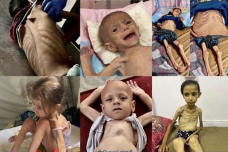 Γάζα: Τα υποσιτισμένα παιδιά τριπλασιάστηκαν από τον Μάρτιο