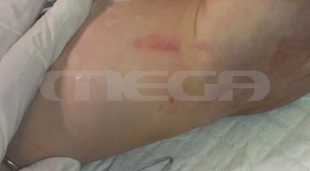 Αποκαλύψεις για το 2,5 ετών βρέφος που πέθανε από κακοποίηση – Τι υποστήριζε τότε ο ιατροδικαστής