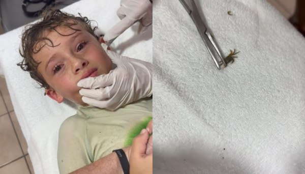 Μεξικό: Καβούρι μπήκε στο αυτί ενός αγοριού – Βίντεο από τη στιγμή που οι γιατροί το βγάζουν ζωντανό