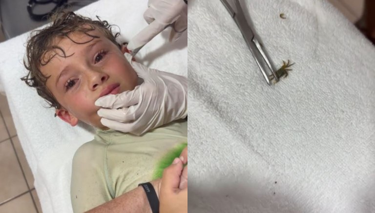 Μεξικό: Καβούρι μπήκε στο αυτί ενός αγοριού – Βίντεο από τη στιγμή που οι γιατροί το βγάζουν ζωντανό