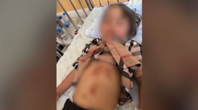 Χαλκιδική: Βίντεο με τον λύκο που επιτέθηκε και τραυμάτισε 5χρονη – Εικόνες από τα τραύματα στο κοριτσάκι