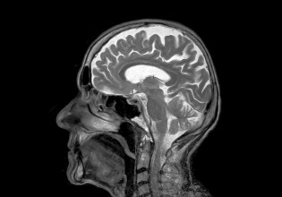 Δεύτερη αιματολογική εξέταση που εγκρίνεται στις ΗΠΑ για την Αλτσχάιμερ – Πόσο αξιόπιστη είναι;