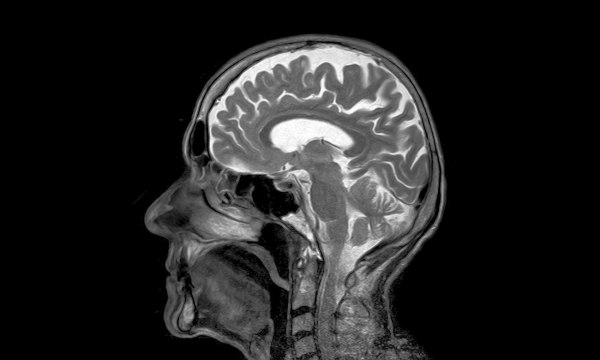 Δεύτερη αιματολογική εξέταση που εγκρίνεται στις ΗΠΑ για την Αλτσχάιμερ – Πόσο αξιόπιστη είναι;