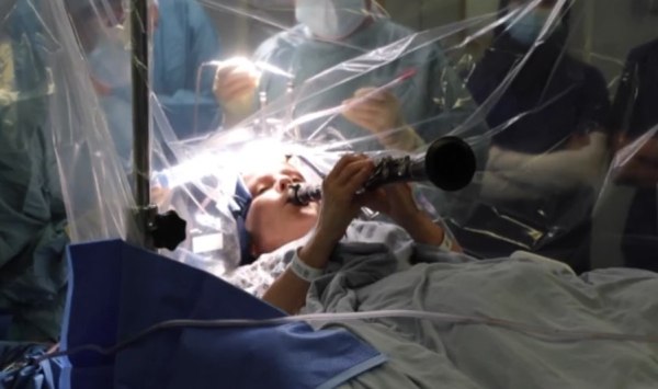 Λονδίνο: Γυναίκα με Πάρκινσον παίζει κλαρινέτο κατά τη διάρκεια εγχείρησης στον εγκέφαλο