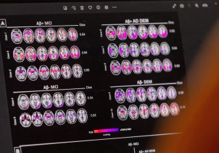 Απέτυχε στις δοκιμές για την Αλτσχάιμερ η θεραπεία της Novo Nordisk για την παχυσαρκία