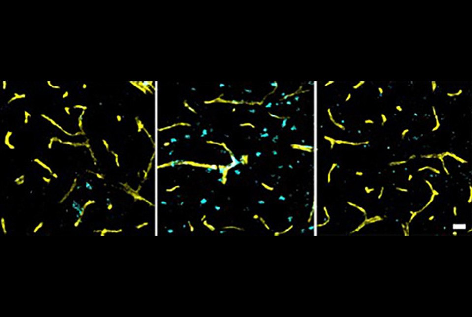 Στον εγκεφαλικό φλοιό ποντικιών χωρίς υπέρταση (αριστερά), τα περισσότερα ενδοθηλιακά κύτταρα είναι φυσιολογικά (κίτρινο χρώμα) και πολύ λίγα εμφανίζουν γήρανση (μπλε χρώμα). Μετά την εισαγωγή αγγειοτενσίνης (μεσαία εικόνα) η οποία προκαλεί υπέρταση, εμφανίζονται πολύ περισσότερα γηρασμένα ενδοθηλιακά κύτταρα (μπλε χρώμα). Το μπλοκάρισμα των υποδοχέων της αγγειοτενσίνης (δεξιά εικόνα) διασώζει τα ενδοθηλιακά κύτταρα του φλοιού. (Dr. Anthony Pacholko)