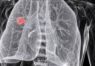 Παγιδευμένοι και απελπισμένοι νιώθουν οι ασθενείς με καρκίνο πνεύμονα