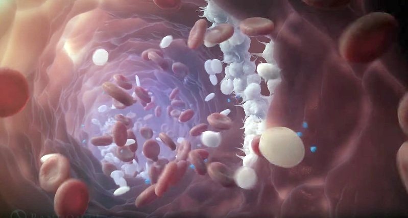 Η υπερχοληστερολαιμία προκαλεί αθηροσκλήρυνση λόγω λιπαρών συσσωρεύσεων στα αγγεία