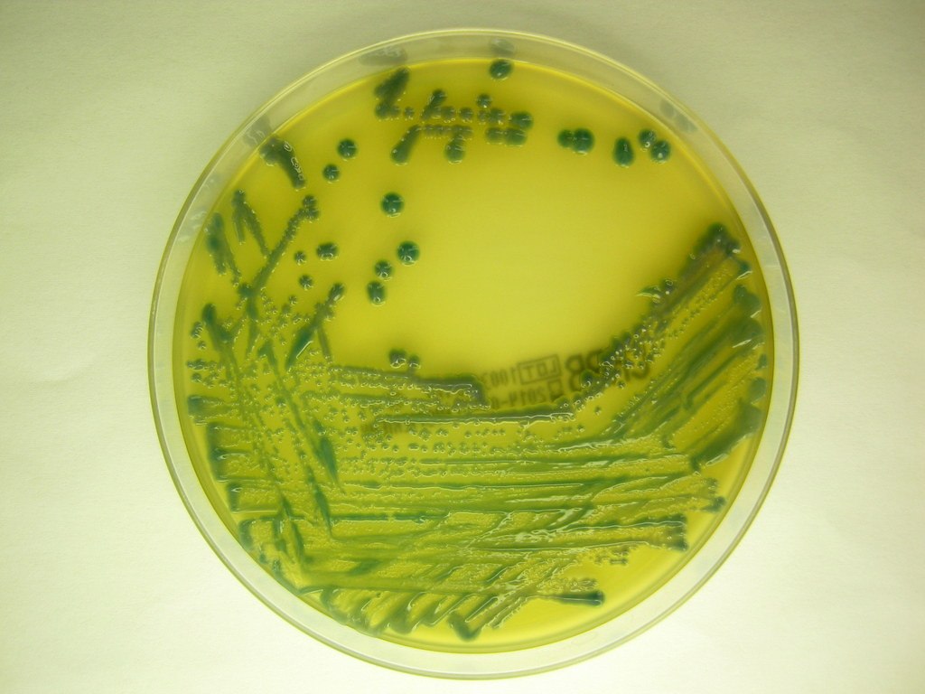 Μείωση 40% των νοσοκομειακών λοιμώξεων απέτρεψε 17.000 μέρες νοσηλείας επιπλοκών