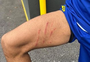 Άρης: Το σημάδι στο πόδι του Ρόουζ από το μαρκάρισμα του Ιβανούσετς (pic)