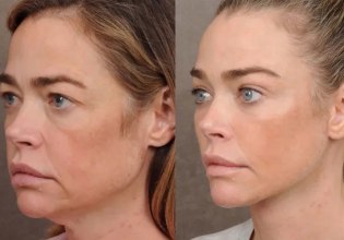 «Φοβόμουν» – Η Ντενίζ Ρίτσαρντς δημοσιεύει φωτογραφίες «πριν και μετά» το λίφτινγκ