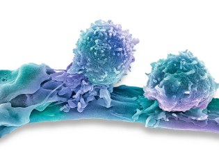 Καρκίνος: Σταθερά στο 7% των δαπανών υγείας – Βελτιώνεται η επιβίωση