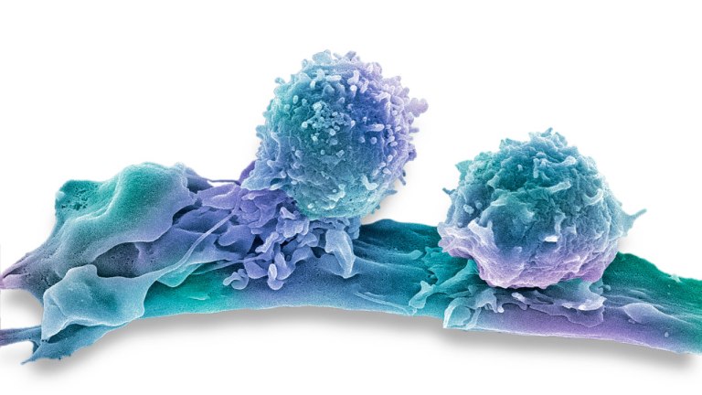 Καρκίνος: Σταθερά στο 7% των δαπανών υγείας – Βελτιώνεται η επιβίωση