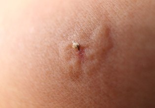 Πότε ένα τσίμπημα μπορεί να οδηγήσει στο θάνατο – Τι είναι το αλλεργικό σοκ και τι πρέπει να προσέξετε