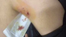 Κρήτη: Άγρια επίθεση σκύλου σε 12χρονο στη Μεσαρά