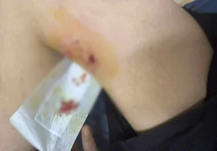 Κρήτη: Άγρια επίθεση σκύλου σε 12χρονο στη Μεσαρά