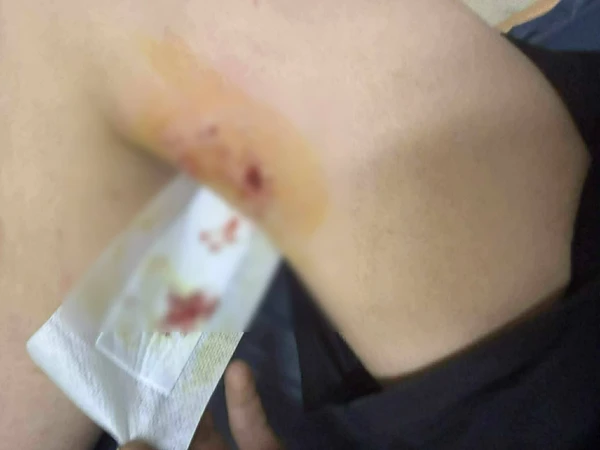 Κρήτη: Άγρια επίθεση σκύλου σε 12χρονο στη Μεσαρά