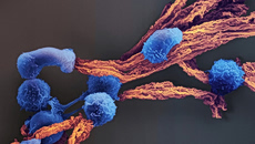 Μία ασθενής, τρία θανατηφόρα αυτοάνοσα – Κυτταρική θεραπεία CAR-T δείχνει να κάνει θαύματα