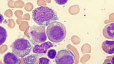 Μυελοδυσπλαστικά Σύνδρομα: Παθοφυσιολογία, διάγνωση και θεραπευτικές προσεγγίσεις