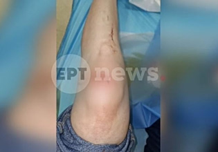 Πάτρα: Συγκλονίζει η γυναίκα που δέχτηκε άγρια επίθεση – «Έχω κατάγματα και μώλωπες»